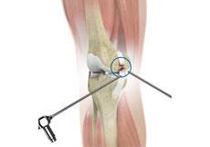 Arthroscopic Knee Ligament Reconstruction